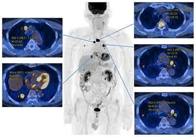 Metabolic parameters on baseline 18F-FDG PET/CT are potential predictive biomarkers for immunotherapy in patients with head and neck squamous cell carcinoma